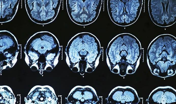 Anvisa aprova novo medicamento para o tratamento do Alzheimer