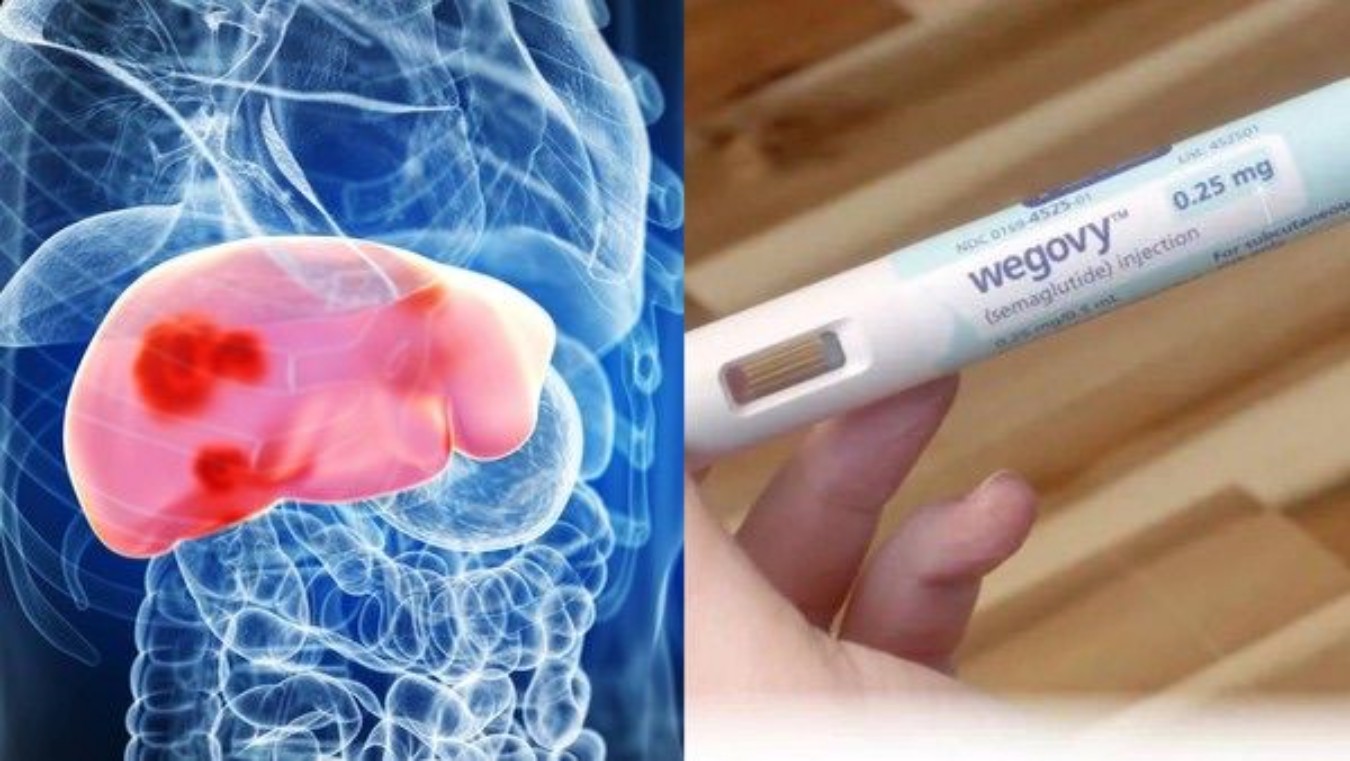 Anvisa aprova semaglutida para tratar doença hepática metabólica