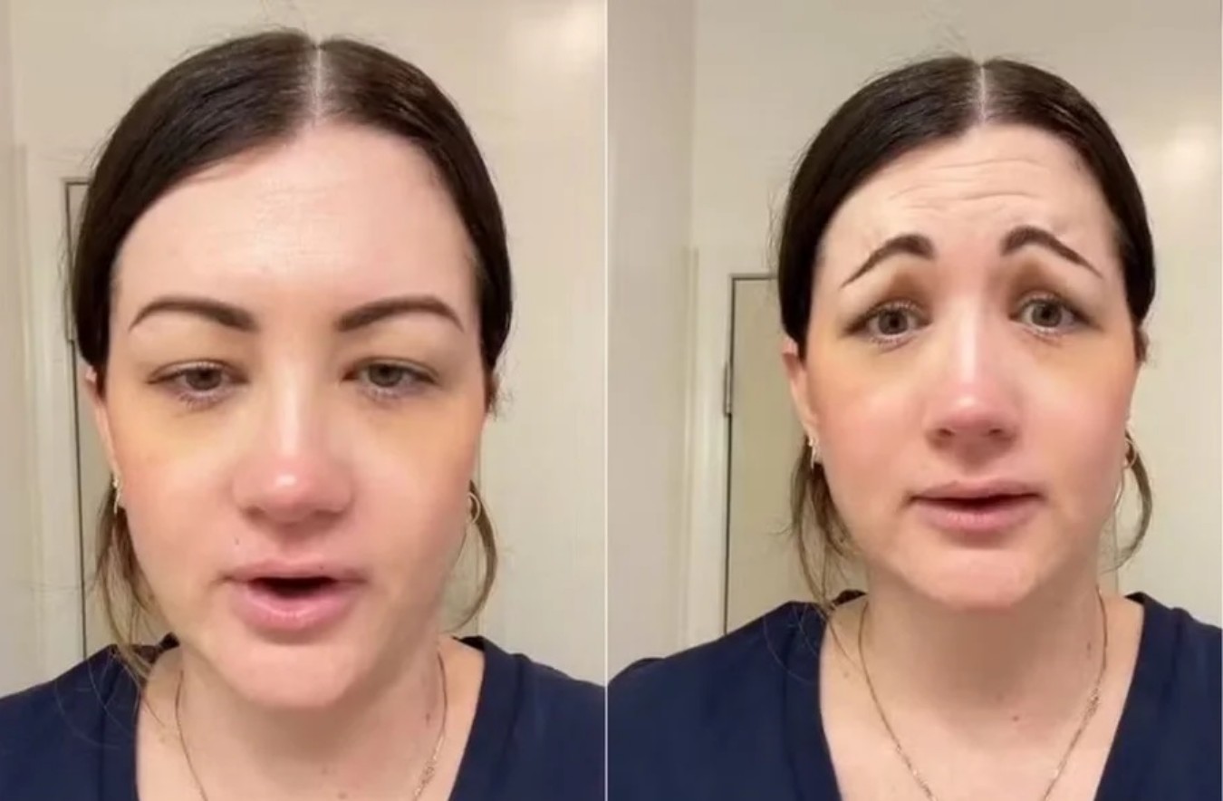 Aplicação de toxina botulínica dá errado e mulher fica com cara de “palhaço triste”