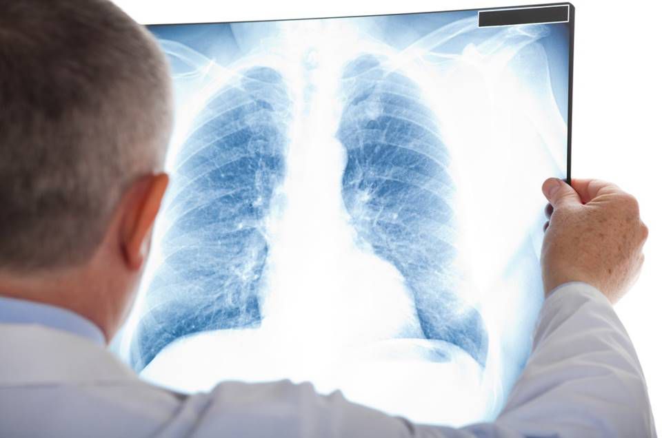 Covid-19 causa danos no pulmão por mais de três meses 