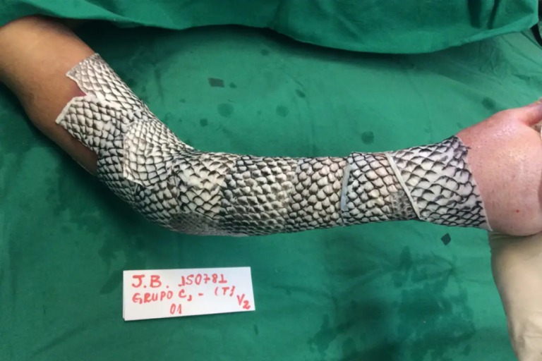 Curativo de pele de Tilápia para queimaduras pode chegar às farmácias em breve