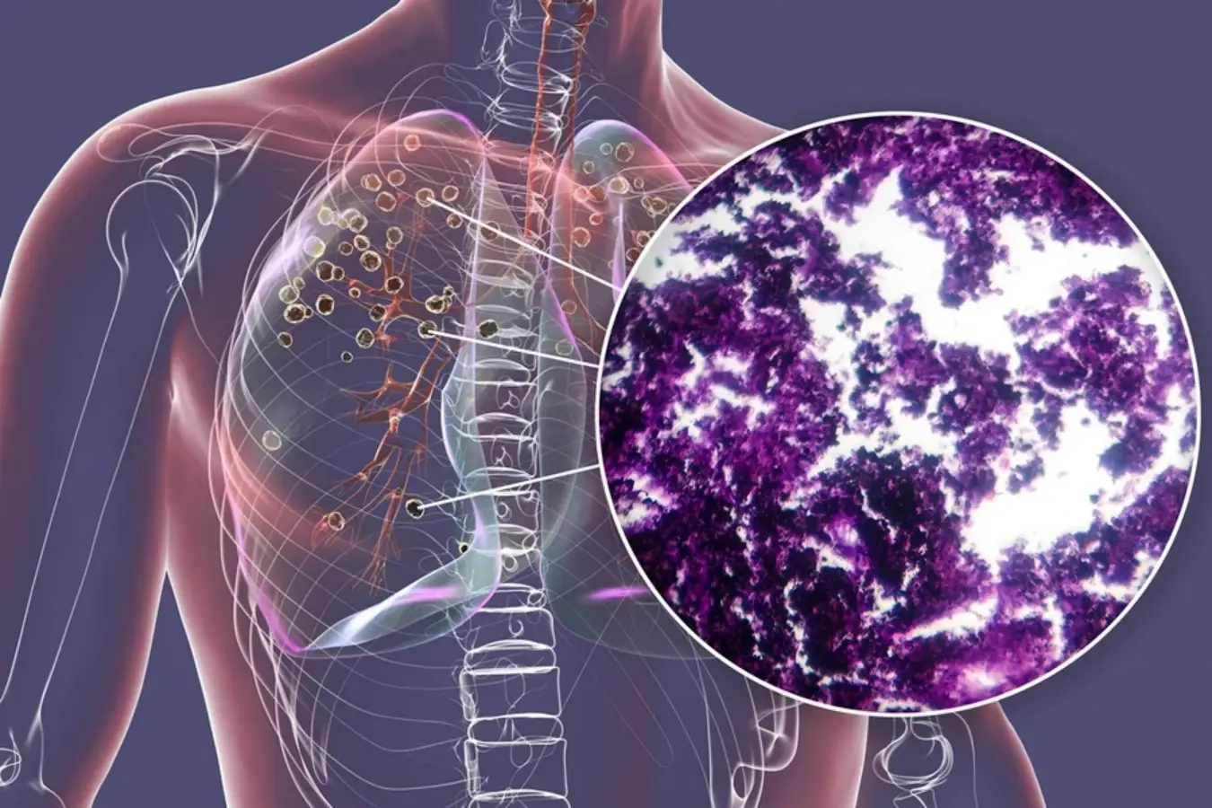 Células do câncer de pulmão usam sistema próprio para manter mutação ativa