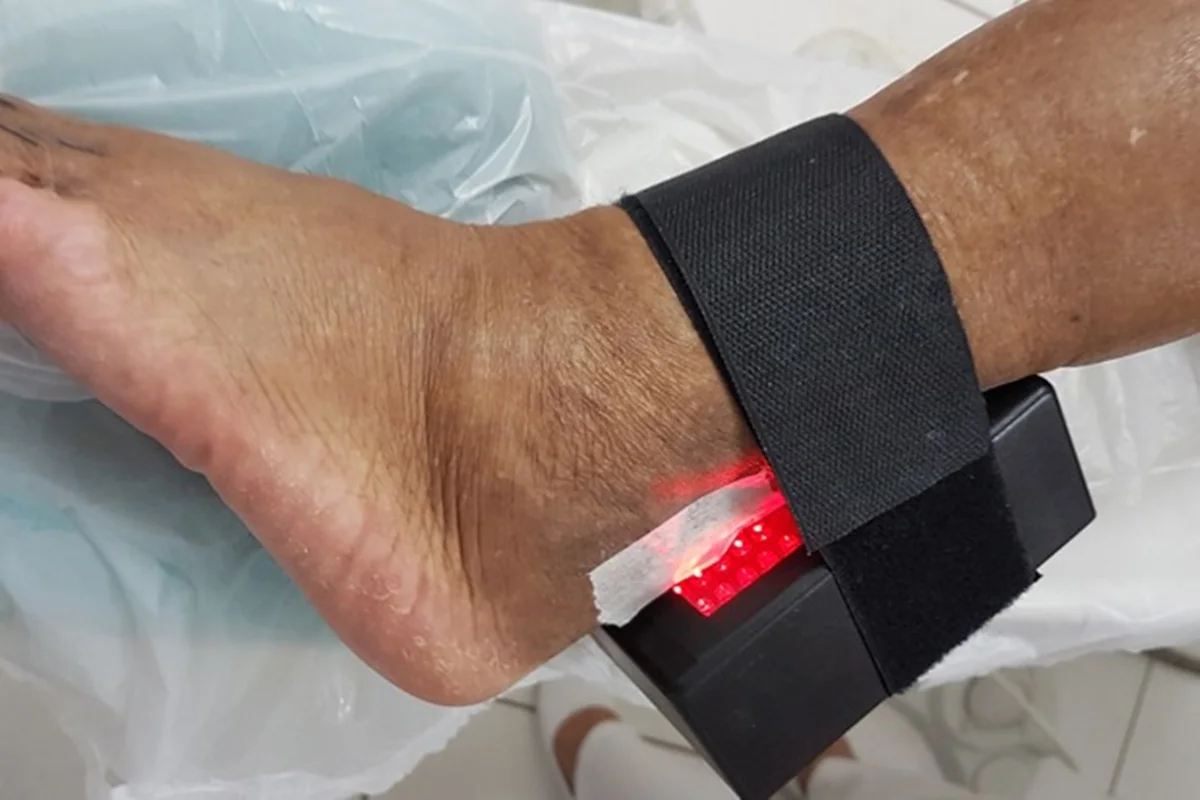 Dispositivo desenvolvido na UnB ajuda a evitar amputações em pacientes diabéticos