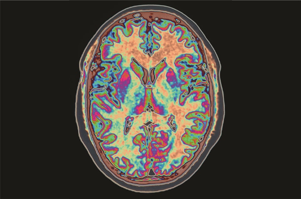 Droga que combate Alzheimer volta à cena como nova promessa