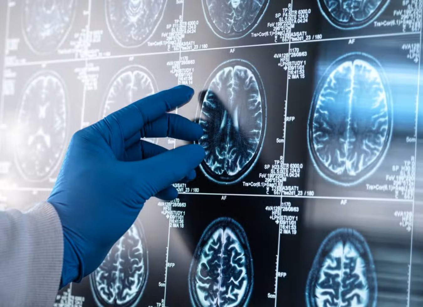 Estudo brasileiro revela que a inflamação no cérebro pode ser a chave para a progressão do Alzheimer.