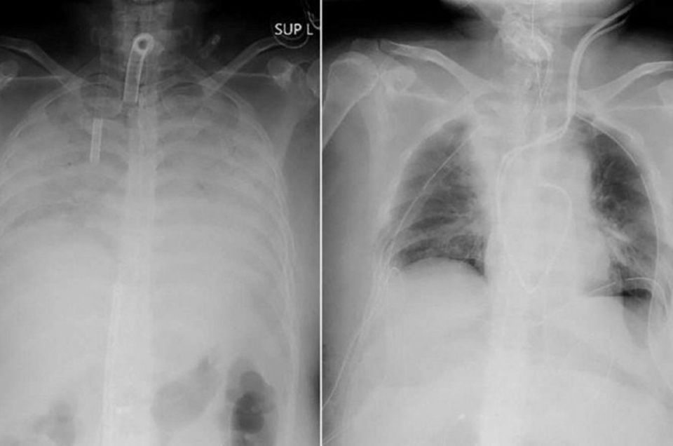 Japão faz 1º transplante de pulmão de doador vivo para paciente com coronavírus