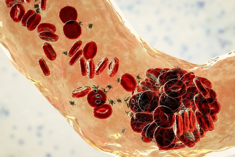 Teste feito em casa para HPV amplia rastreamento do câncer do colo do útero