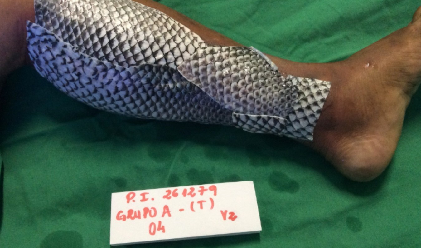 Universidade Federal do Ceará mantém patente e licencia exploração do curativo de pele de tilápia