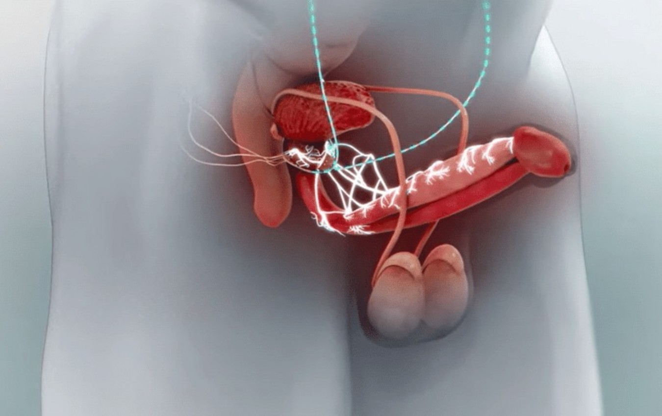 Viagra eletrônico: dispositivo criado por brasileiro recupera a ereção em 90% dos pacientes em estudo