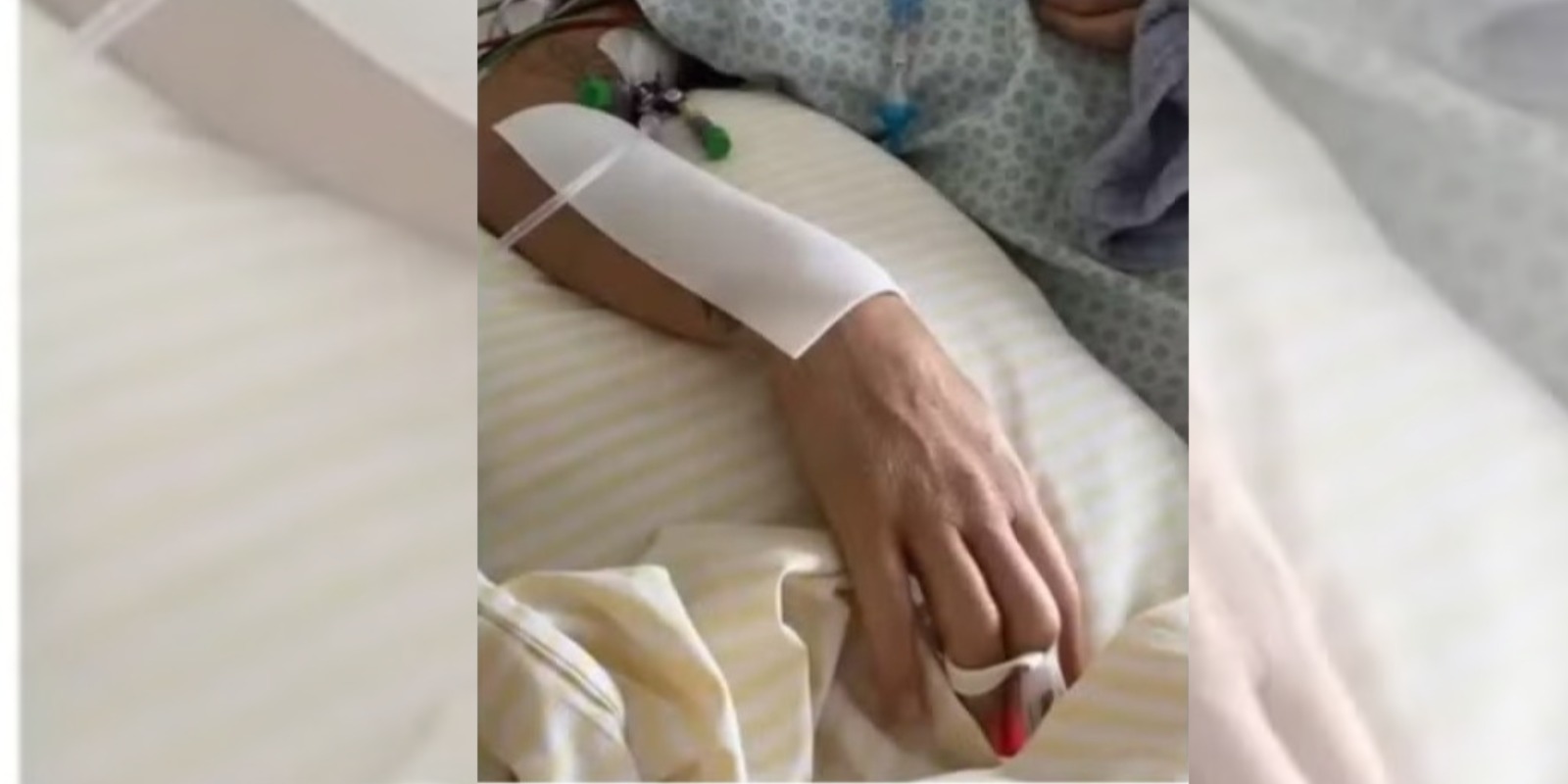 Polilaminina permite que paciente volte a mexer o braço após lesão na coluna