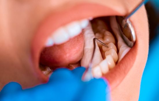 Pesquisadores desenvolvem flúor capaz de regenerar dentes danificados pela cárie